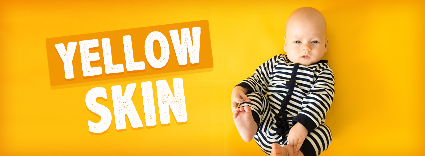 A baby dressed in striped pajamas with yellow skin, representing the visual signs of jaundice in infants.